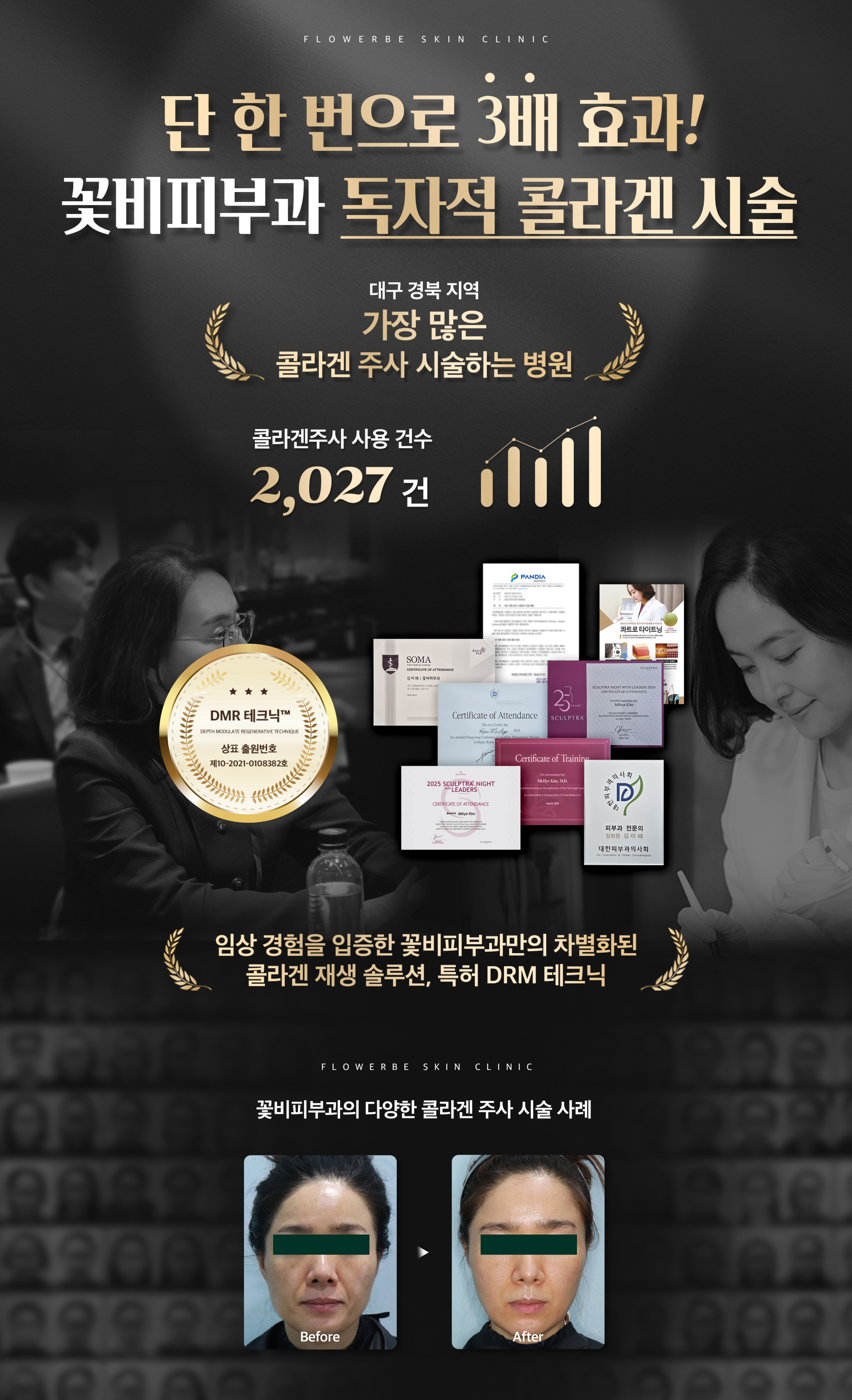 콜라겐재생술